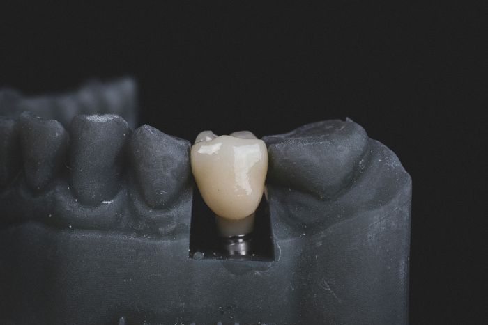 Zubní implantáty fotka