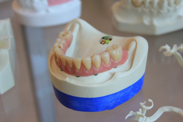 Zubní implantáty fotka